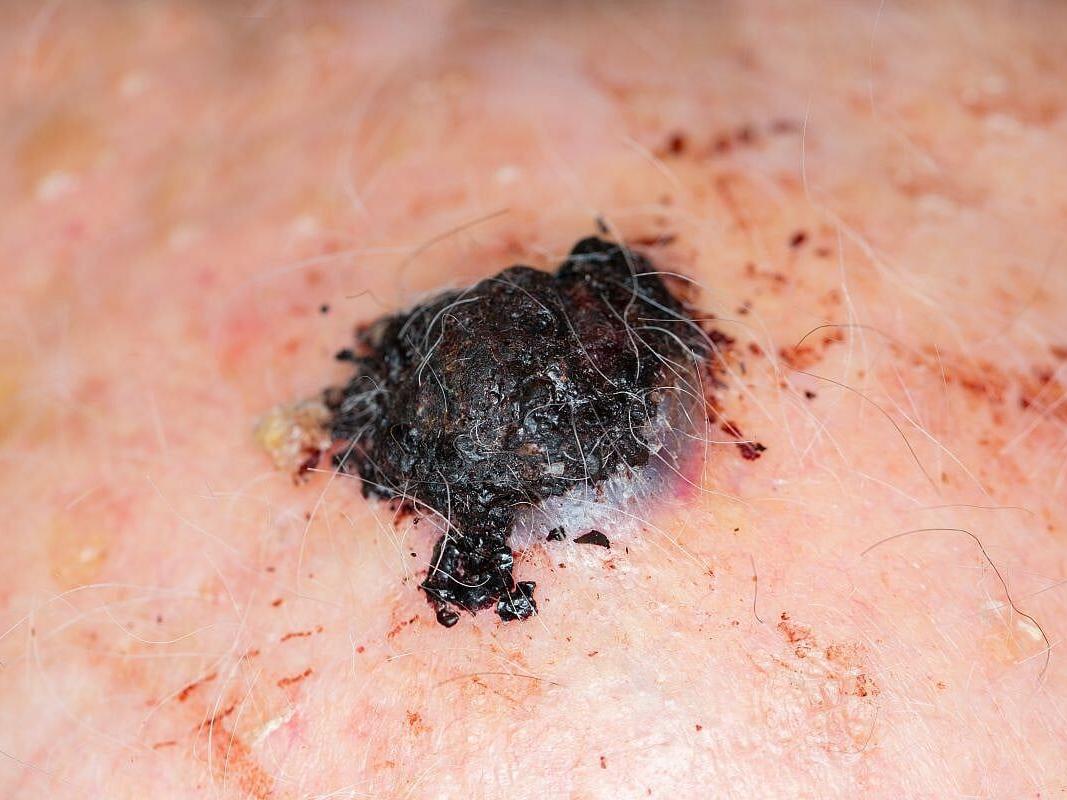 Gene Test Might Spare Biopsy Surgery For Some Melanoma Patients